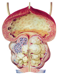 hiperplazija prostate)